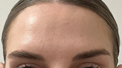 after botox