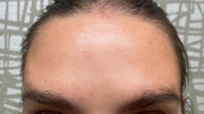 after botox