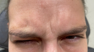before botox