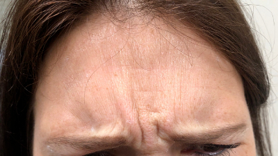 before botox