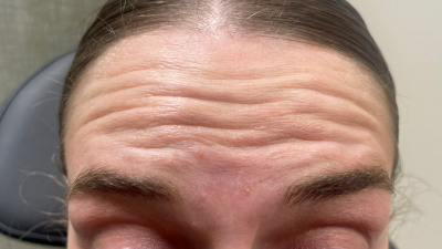 before botox