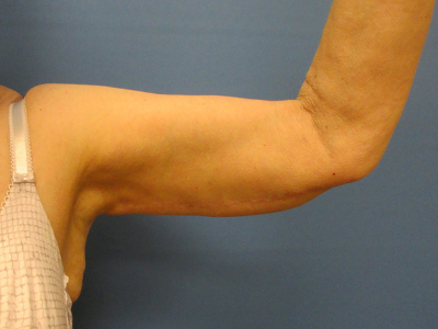 after brachioplasty