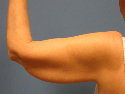 before brachioplasty