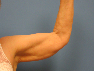 before brachioplasty