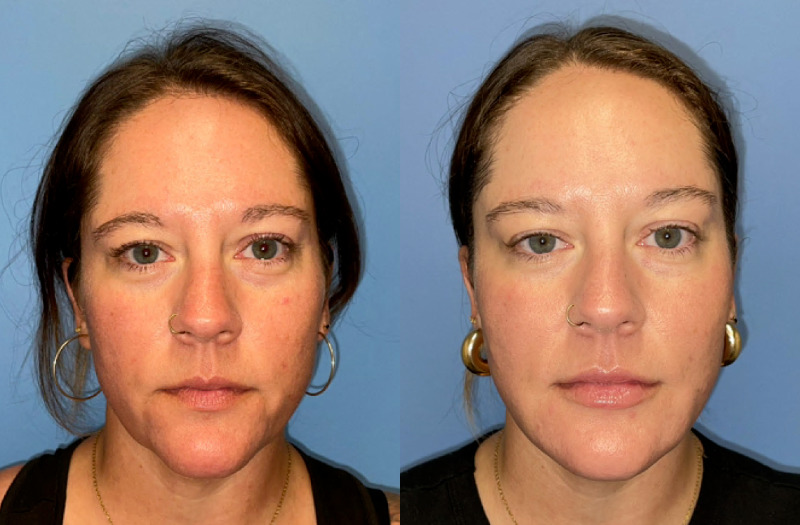 before and after facial rejuvenation