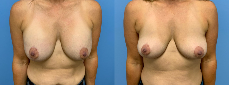 before and after implant removal