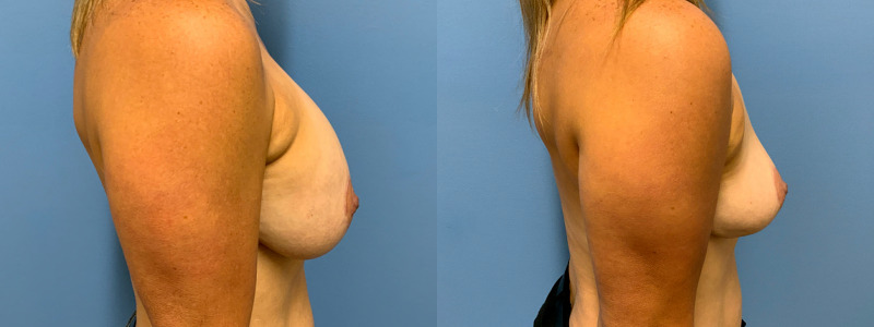 before and after implant removal