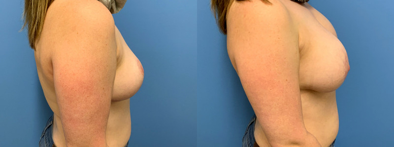 before and after implant removal