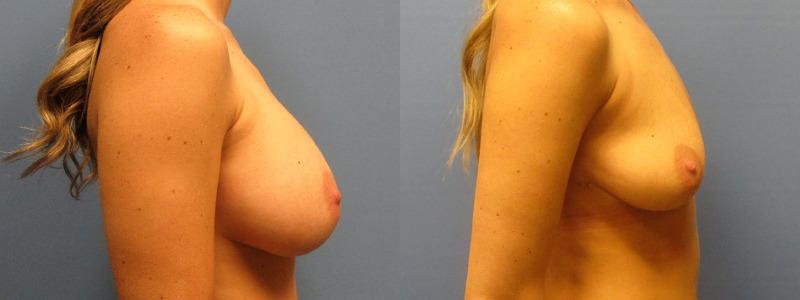 before and after implant removal