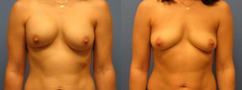 before and after implant removal