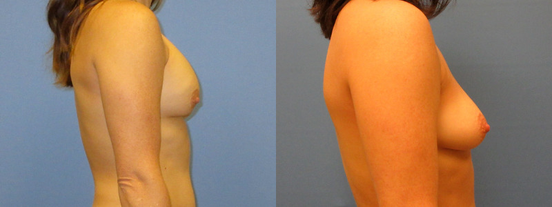before and after implant removal