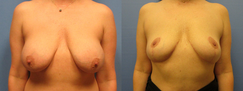 before and after implant removal