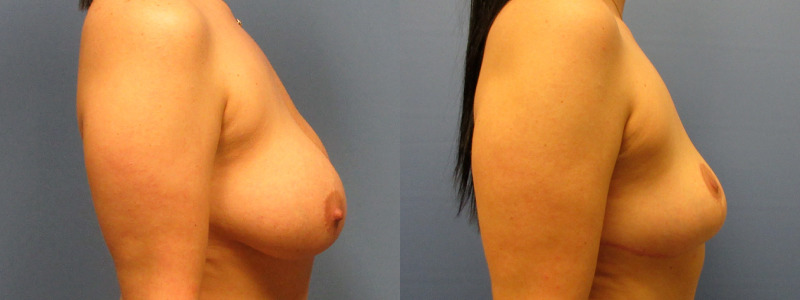before and after implant removal