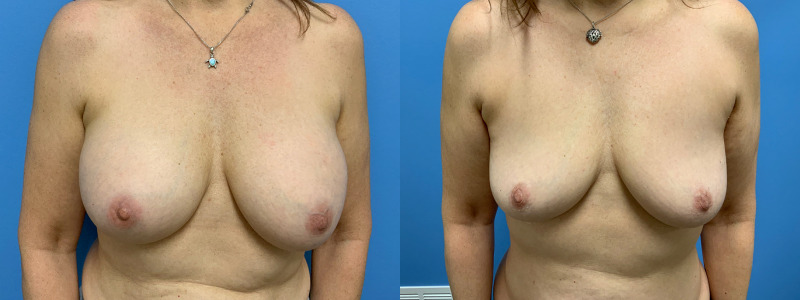 before and after implant removal