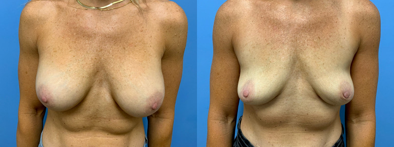 before and after implant removal