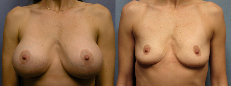 before and after implant removal