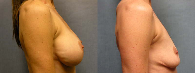 before and after implant removal