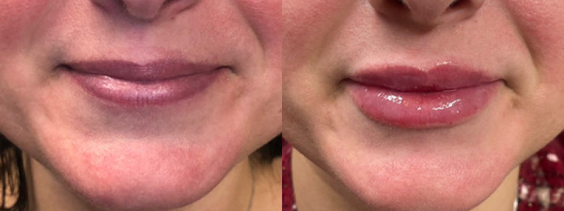 before and after lip filler