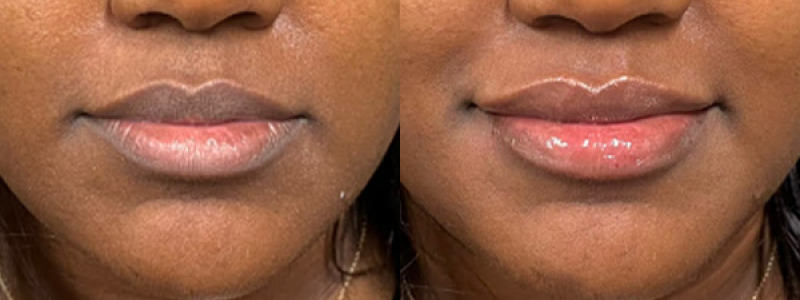 before and after lip filler