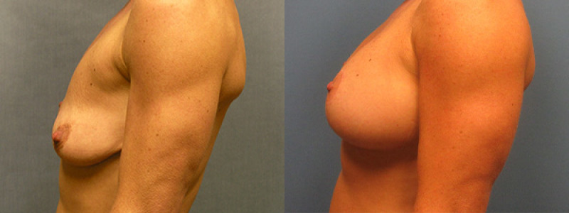 before and after pexyaug