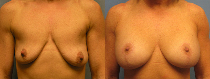 before and after pexyaug