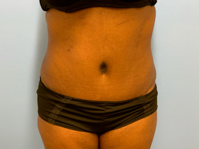 after abdominoplasty
