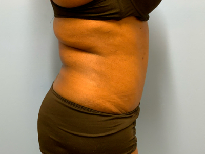 after abdominoplasty