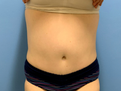 after abdominoplasty