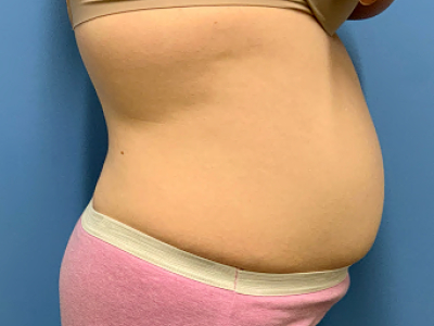 before abdominoplasty