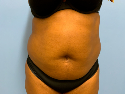 before abdominoplasty