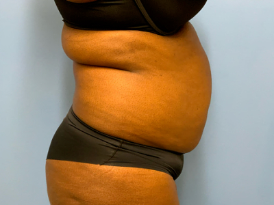 before abdominoplasty