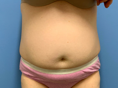 before abdominoplasty