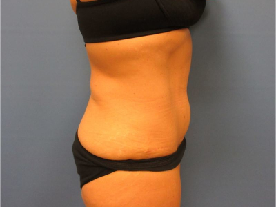 after abdominoplasty