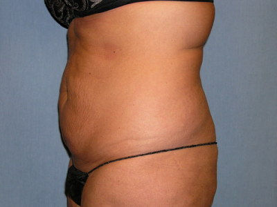 before abdominoplasty