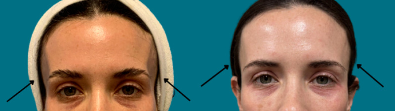before and after facial rejuvenation