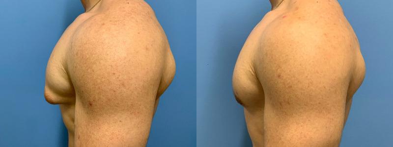 before and after gynecomastia