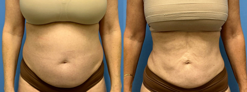 before and after liposuction