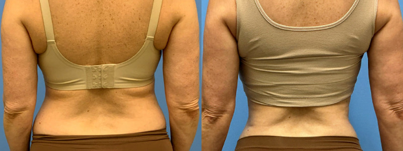 before and after liposuction