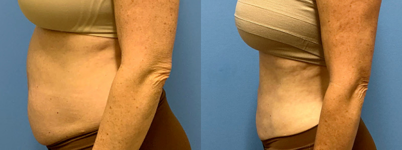 before and after liposuction