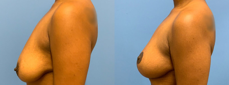 before and after mastopexy with implants