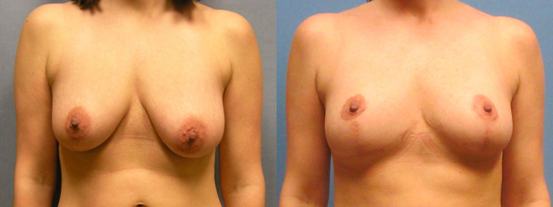 before and after mastopexy with implants