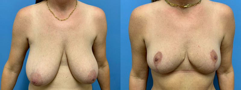 before and after mastopexy with implants