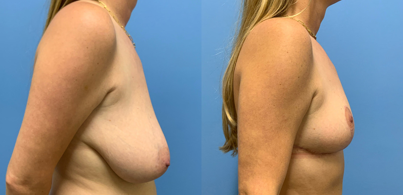 before and after mastopexy with implants