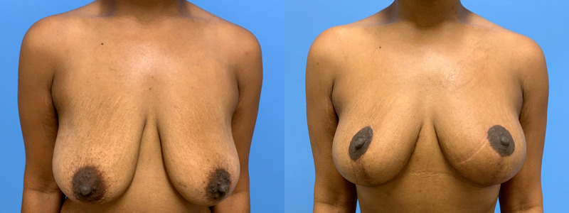 before and after mastopexy with implants
