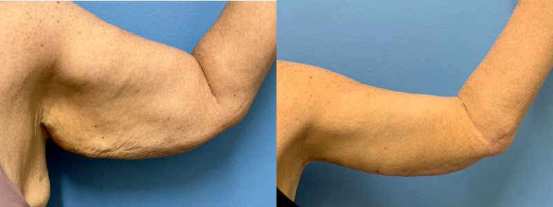 before and after brachioplasty