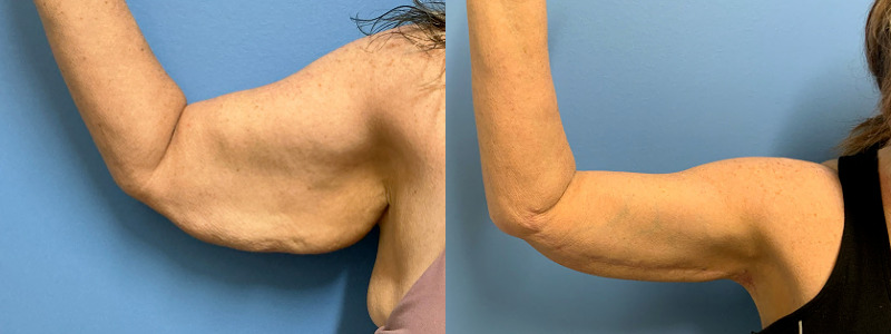 before and after brachioplasty